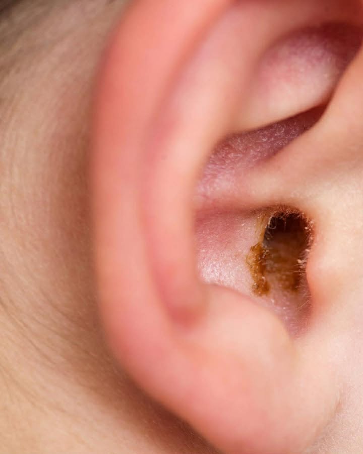 Close-up of ear wax build-up